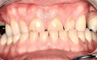 Bruxism