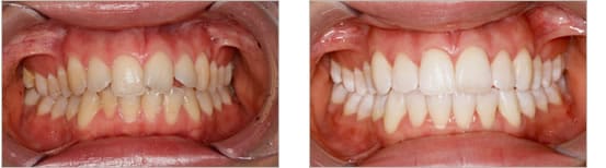 Before and after invisalign treatment