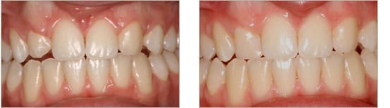Before and after tooth shaping
